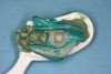 Fig 6. From a more anterior view, it was apparent that the labial positioning of these implants was outside the alveolar housing.