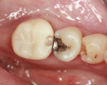 Figure 13  Provisional Bis-acryl crown with a mesial slot to interlock.