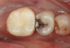 Fig 8. A mucogingival deformity existed on the premolar implants.