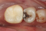 Figure 14  Provisional crown cemented with composite placed in the slot.
