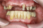 Figure 17  Prepared teeth showing gingival healing after 7 weeks.