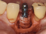Fig 2. Implant inserted through allograft ring.