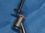 Fig 8. Trimming of the allograft ring.