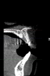 Fig 4. Large incisive canal.