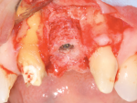 Fig 9. Implant placed through allograft ring in native bone.