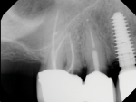 Fig 14. Preoperative periapical radiograph.