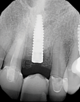 Fig 12. Postoperative periapical
radiograph of implant and allograft ring
replacement.