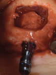 Fig 18. Allograft ring and implant placement.