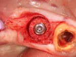 Fig 28. Allograft ring and implant fixation.