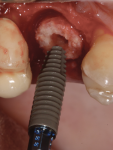 Fig 24. Bone-level tapered implant placed through allograft ring.