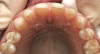 Fig 1. Presurgical panoramic radiograph of a patient with severe periodontal disease and who is an All-on-4–style treatment candidate.