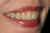 Fig 11. Accessory mental foramina (arrows) encountered during mandibular All-on-4–style dental implant surgery.