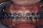 Figure 2  Preoperative orthodontic view.