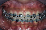 Figure 3  Postoperative orthodontic view.