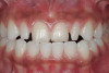 Fig 17. Postsurgical panoramic radiograph of the patient from Figure 16 following All-on-4–style dental implant treatment.