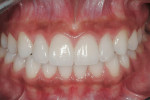 Figure 5  Porcelain veneers on teeth 7 through 10.
