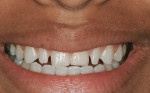 Figure 6  Preoperative smile.