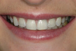 Photograph of patient after single tooth whitening treatment.