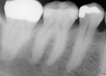 Figure 2  X-rays of teeth Nos. 29 through 31 showed decay.