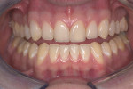 Figure 2  Compared to the preoperative photograph, the incisal translucency of the newly restored teeth harmonizes with the balance of the smile. The unique incisal edge contours enhance the natural appearance as the direct composites blend into the