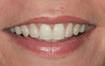 Figure 1  Natural smile before treatment.