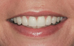 Figure 11  Natural smile with veneers inserted.