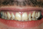 Figure 1  Preoperative retracted view of the patient’s smile.