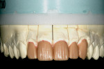 Figure 2  View of the completed wax-up of the five maxillary veneer restorations.