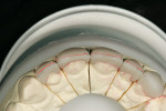 Figure 3  After the facial incisal edge was marked with a red pencil, a 0.3-mm lead pencil line was placed 0.5 mm lingually.