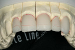 Figure 4   The facial incisal area was beveled back 0.5 mm using a Komet 9001 centered diamond stone.