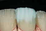 Figure 12  IPS e.max Opal Clear (color tagged blue) filled in the mesial and distal incisal grooves.