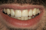 Figure 16  Postoperative view of the patient’s natural smile.