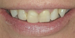Figure 1  Pretreatment natural smile.