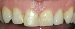 Figure 2  Pretreatment; note the gingival contours and coronal coverage.