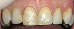 Figure 3  Immediate posttreatment; note the gingival height and absence of bleeding.