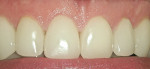 Figure 4  One week posttreatment with provisional restorations; note the consistency of the gingival height with the immediate postoperative image and the healthy, stippled consistency of the gingival tissue. <em>Photos courtesy of Dr. Michael Swick.