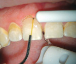 Figure 5  The movement of the laser fiber in a back-and-forth motion similar to that of a pencil eraser, with the fiber parallel to the long axis of the tooth with the laser energy directed away from the tooth structure.