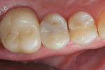 Figure 2  A 4-year recall image of a tooth restored with Surpass, a flowable composite (Titan, Apex), and a microhybrid (Vit-l-escence<sup>®</sup>, Ultradent).