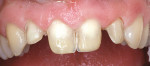 Figure 7  The IPS Empress Direct composite in shade B1 enamel was placed, sculpted, and cured