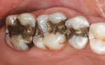 Figure 1  Preoperative condition of the maxillary left posterior teeth.
