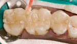 Figure 9: All porcelain restorations were placed and excess cement was cleaned with microbrushes.