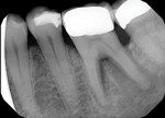 Eighteen months later, a periapical radiograph revealed progression of periodontal attachment loss. An apicomarginal bony defect was noted surrounding the distal root, furcal bone loss was evident, and a radiolucency was noted at the apex of the distal root. Clinical testing indicated the tooth was necrotic; however, the patient refused treatment.
