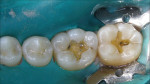 Figure 2  The amalgams were removed and the caries underneath was excavated.