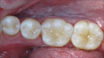 Figure 9: Astropol rubber points, wheels, and brushes wereused for occlusal adjustments and polish.