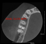 Figure 1  An axial MPR showed mesial–buccal roots in the first, second, and third molars.