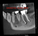 Figure 3  A sagittal MPR showed an unfilled canal and a radiolucency.