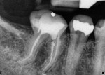 Figure 5  A periapical radiograph showed a normal fill with a radiolucency.
