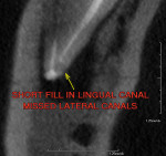 Figure 6  Short fill and missed accessory canals.