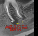 Figure 7  Sagittal MPR showing periapical lesions on both mesial and distal root tips.