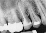 Figure 8  A periapical radiograph showing filled canals and radiolucency.